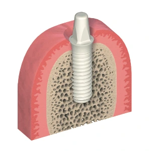 Metal Free Dental Implants