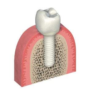 Metal Free Implant