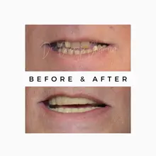 Before After 1