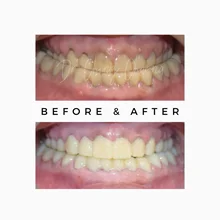 Before After 10