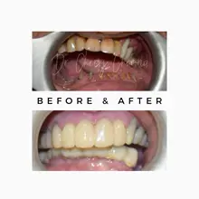 Before After 11