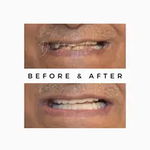 Before After 2