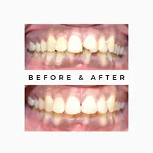 Before After 8