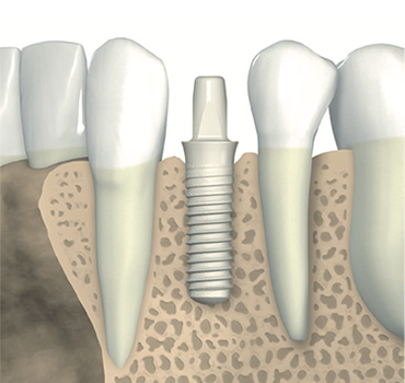 Metal Free Dental Implants – Rule 2